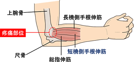 肘の痛みが改善されない原因とは？