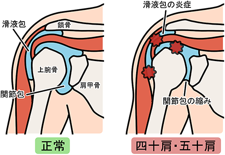 五十肩・四十肩が改善されない理由