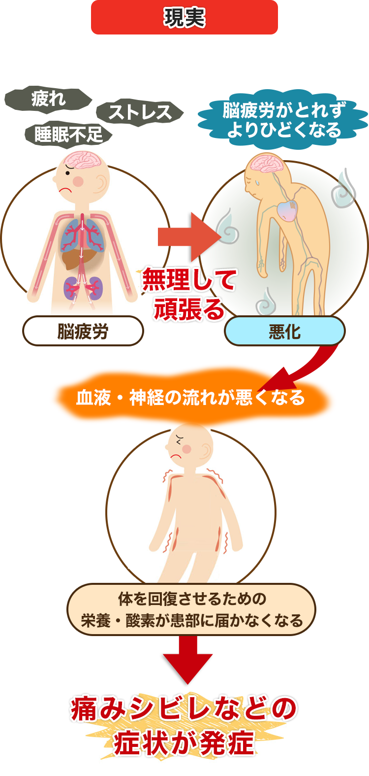 痛みシビレなどの症状が発症