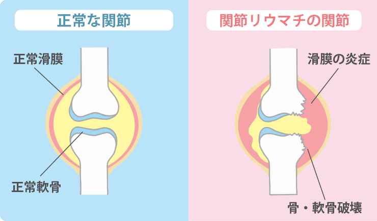 リウマチの改善が難しい理由