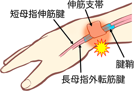 腱鞘炎が改善されない原因とは？