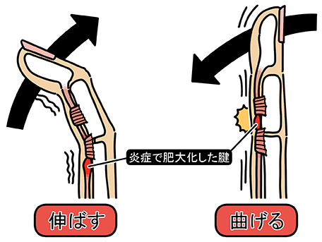 バネ指が改善されない原因とは？