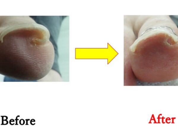 歩き方が悪くて片側だけ巻き爪がひどくなりました。
