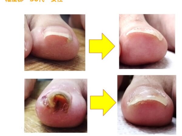 爪が強く食い込んで、痛みも出血もあり辛かったです